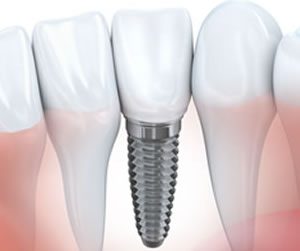 Link to more info about Implant Dentistry
