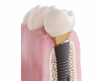 Choosing a Professional for Your Dental Implants in Sicklerville