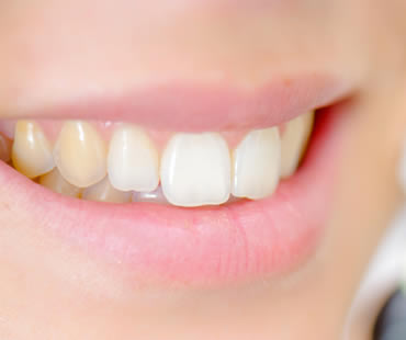 Reasons Your Teeth May No Longer Be White