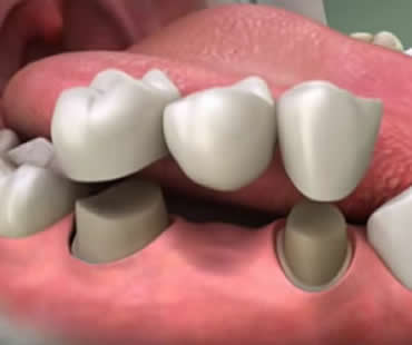 Private: Understanding the Basics About Dental Crowns and Dental Bridges