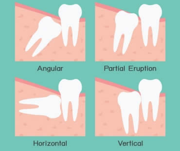 Wisdom Teeth: Keep Them or Let Them Go?
