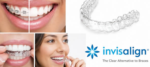 invisalign-1x