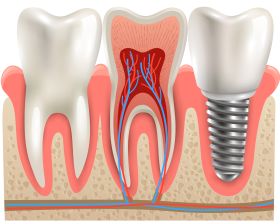 Smile Confidently: Unveiling the Benefits of Dental Implants